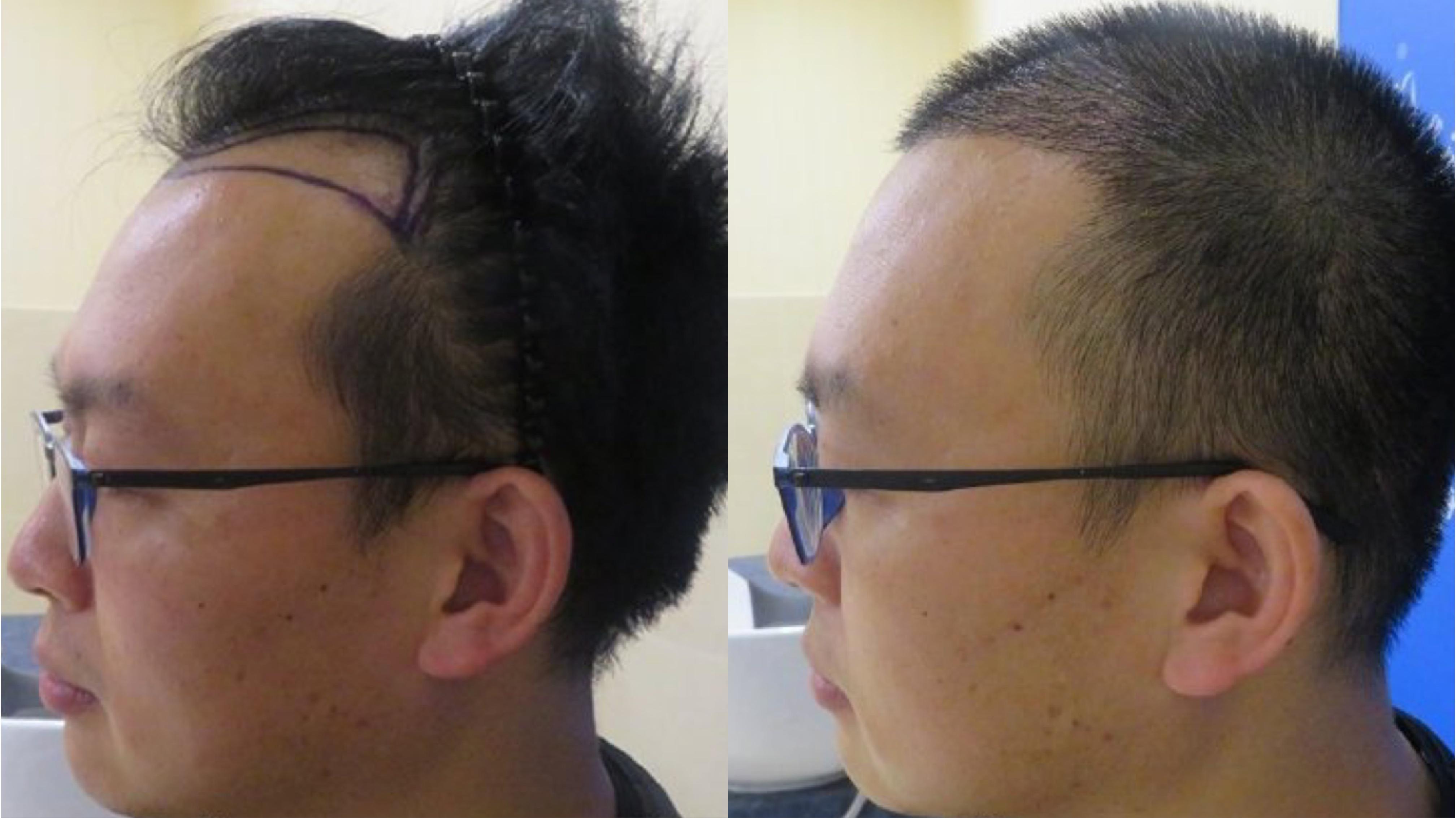 杭州植发医院排名(杭州植发医院排名前三的)-第2张图片